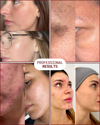 BIO-X Spicule Peel Set