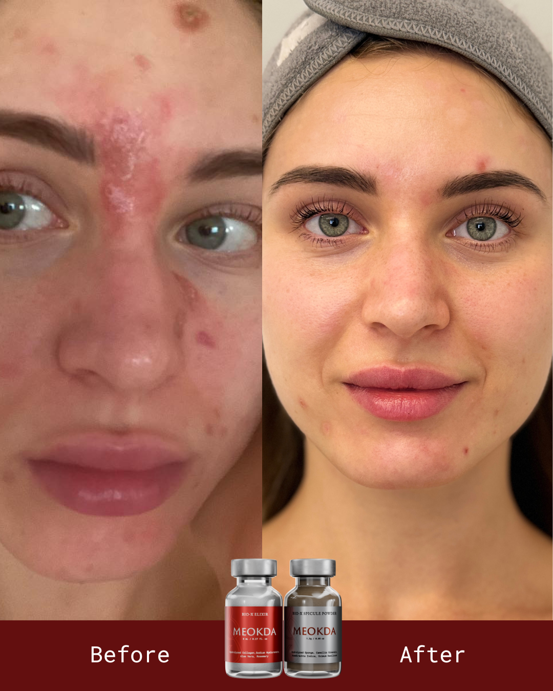 BIO-X Spicule Peel Set